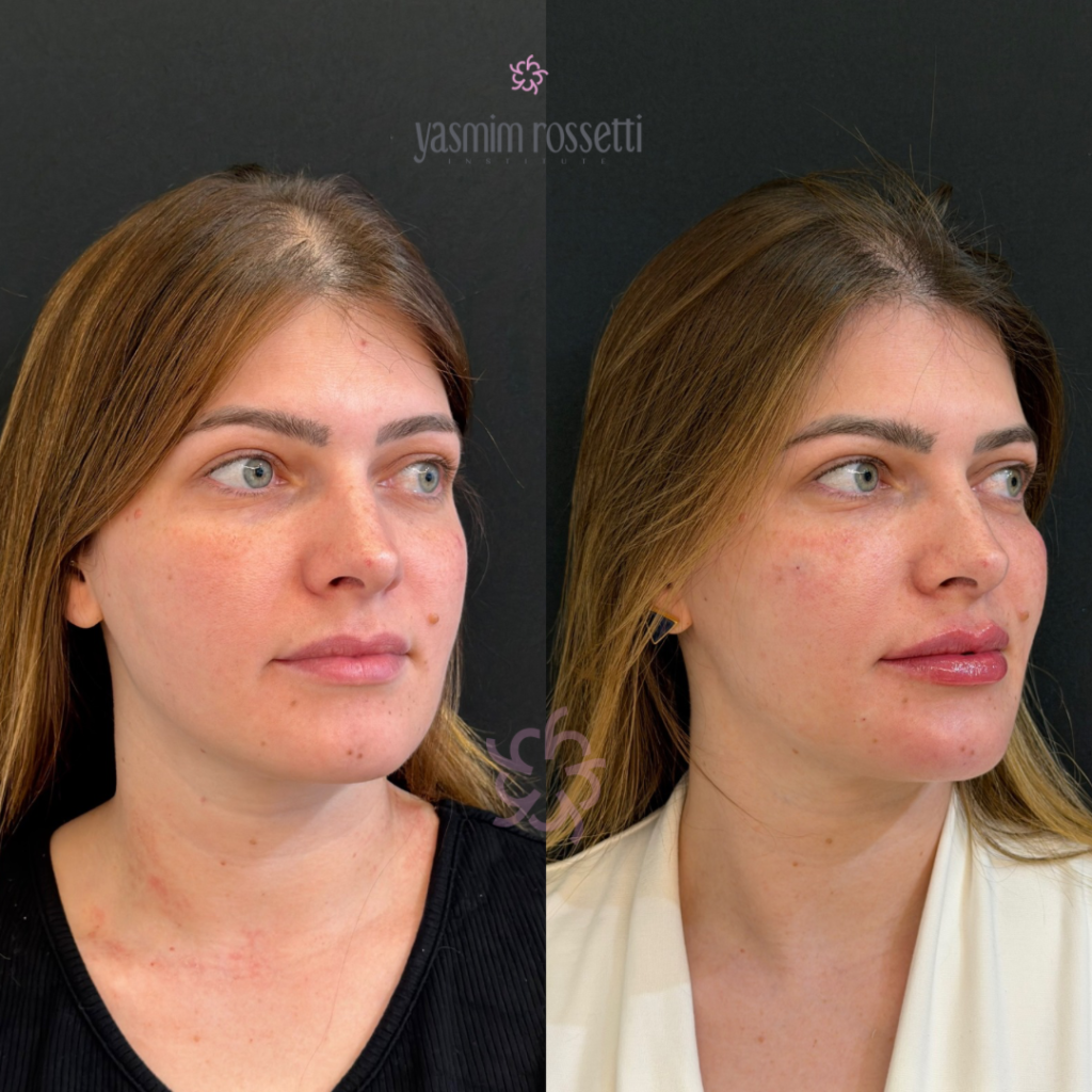 01_Antes e depois- quadrado